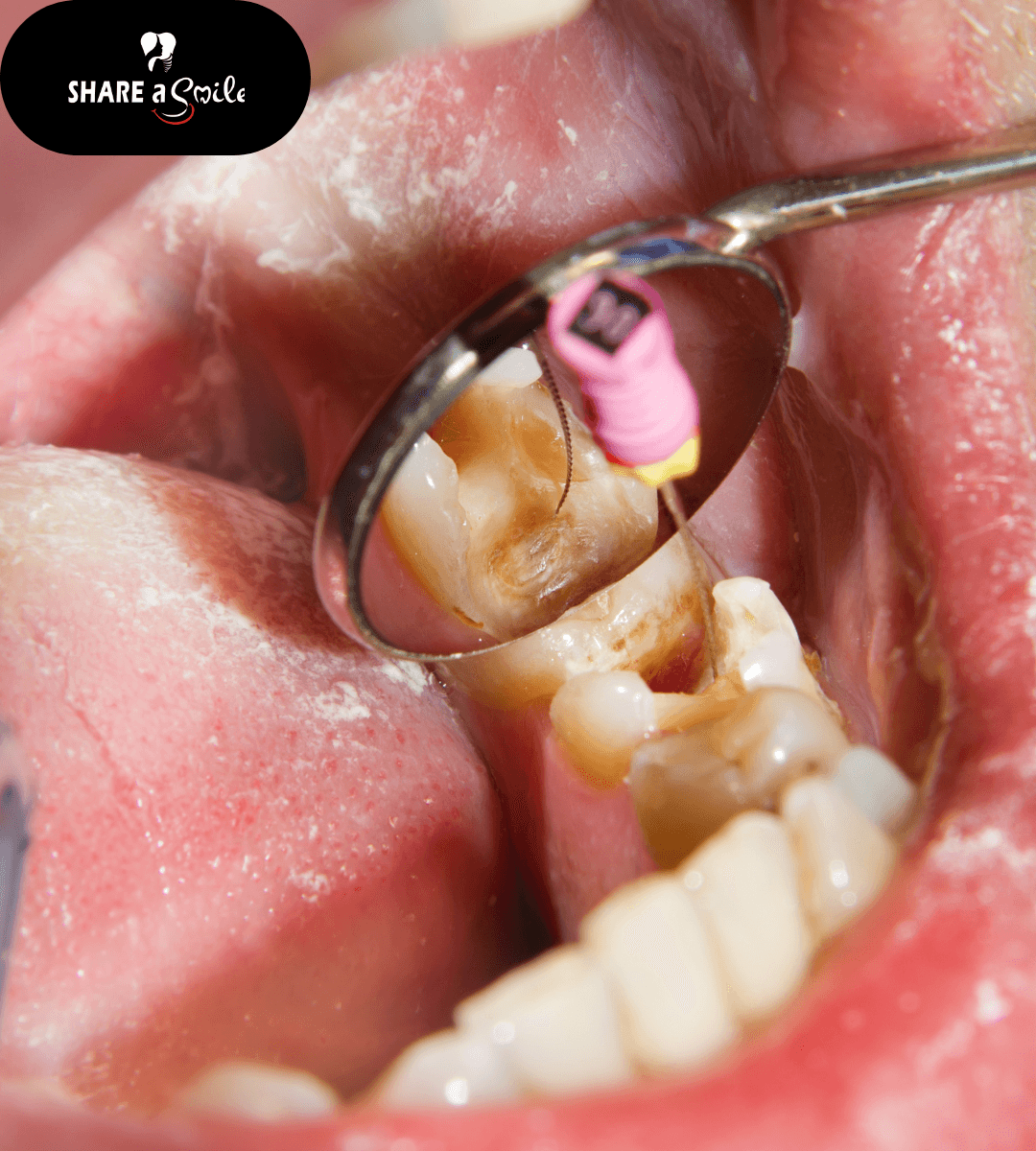 Root Canal Treatment in adoor, Pathanamthitta