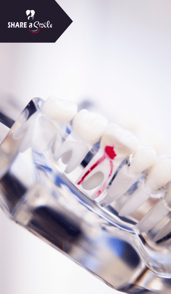 Root Canal Treatments In Pandalam