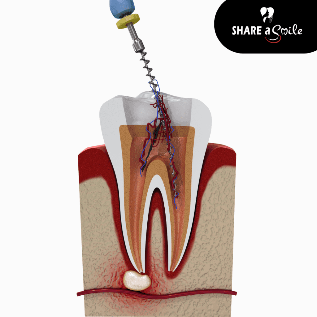 Top Root Canal Treatments In Pandalam