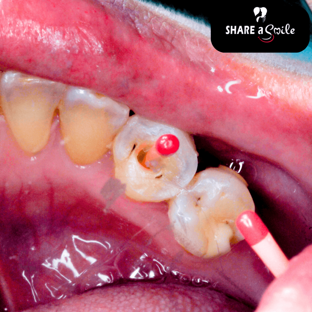 Best Root Canal Treatments In Pandalam