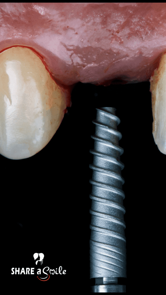 dental implantology in pandalam