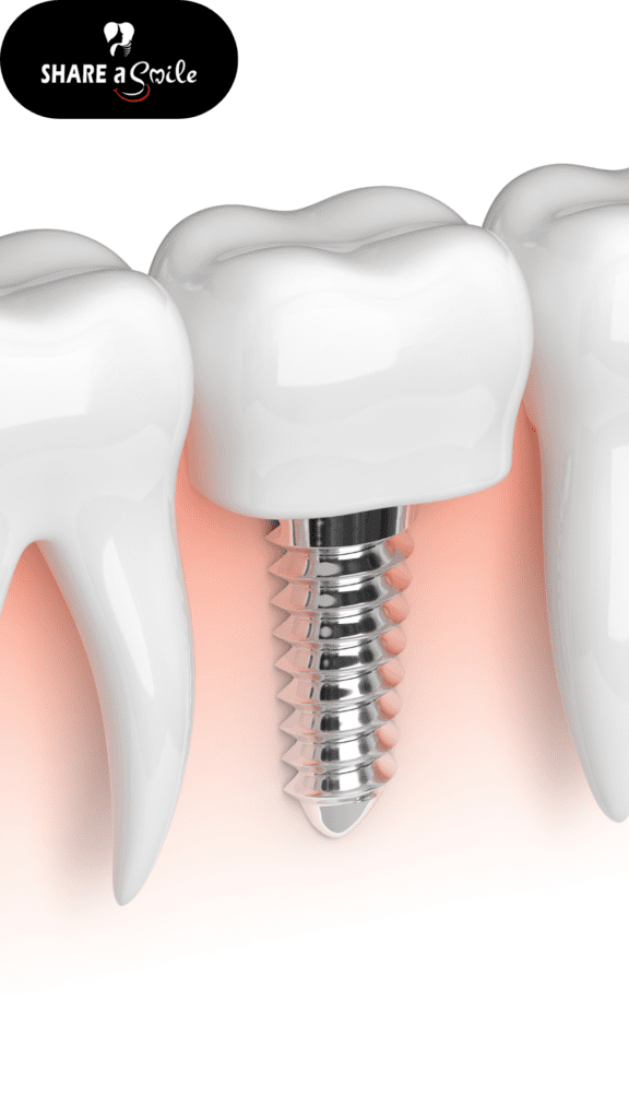 dental implants in pandalam