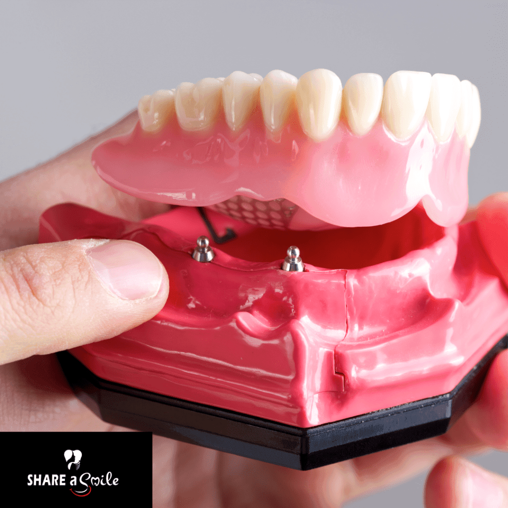 Implant supported complete denture in pandalam