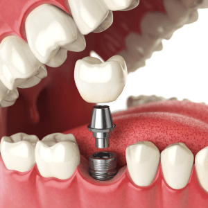 dental implants, dental clinic in pandalam, pathanamthitta