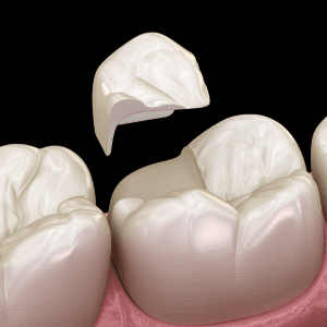 Inlays, dental clinic in pandalam, pathanamthitta